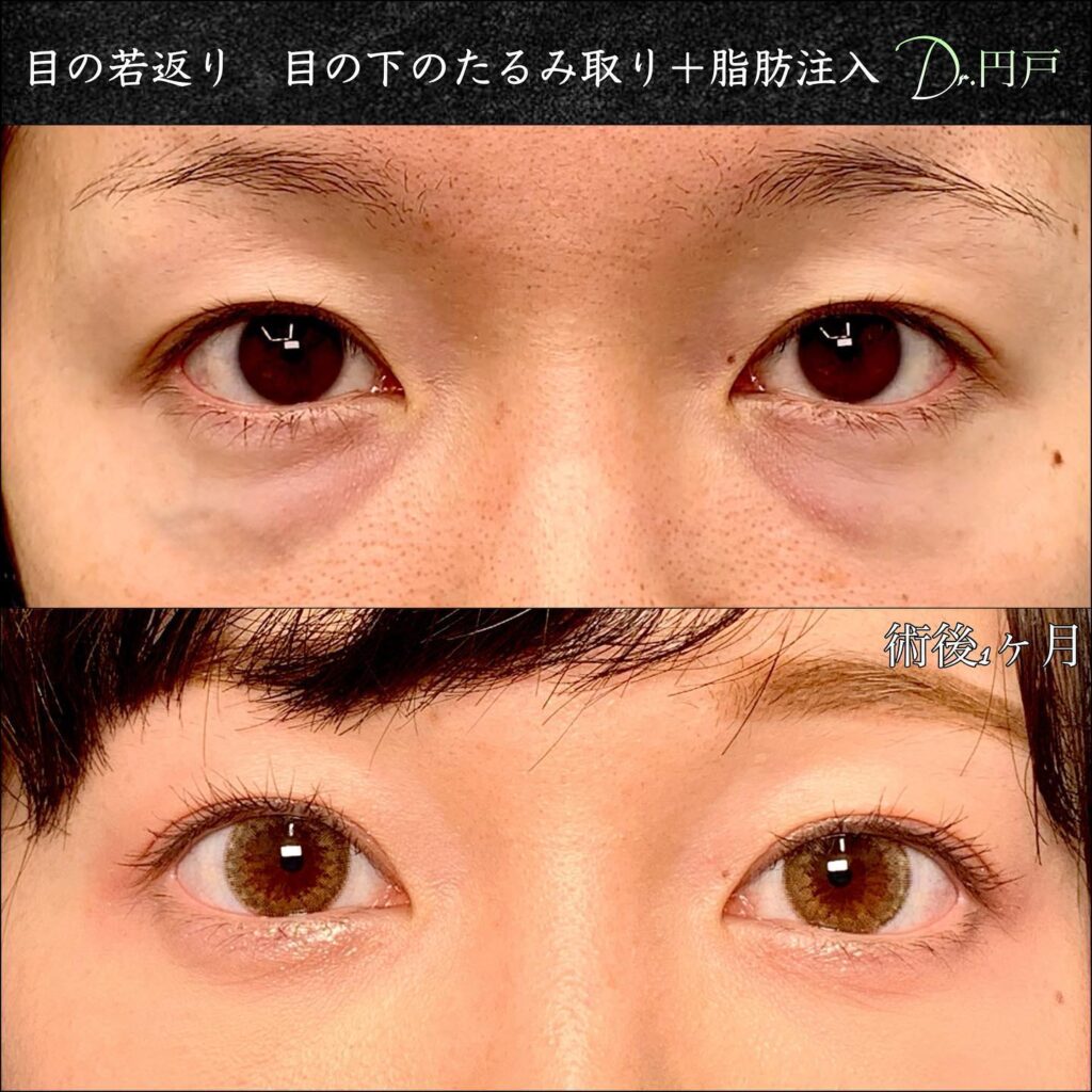 目の下のたるみ取りと脂肪注入の症例写真