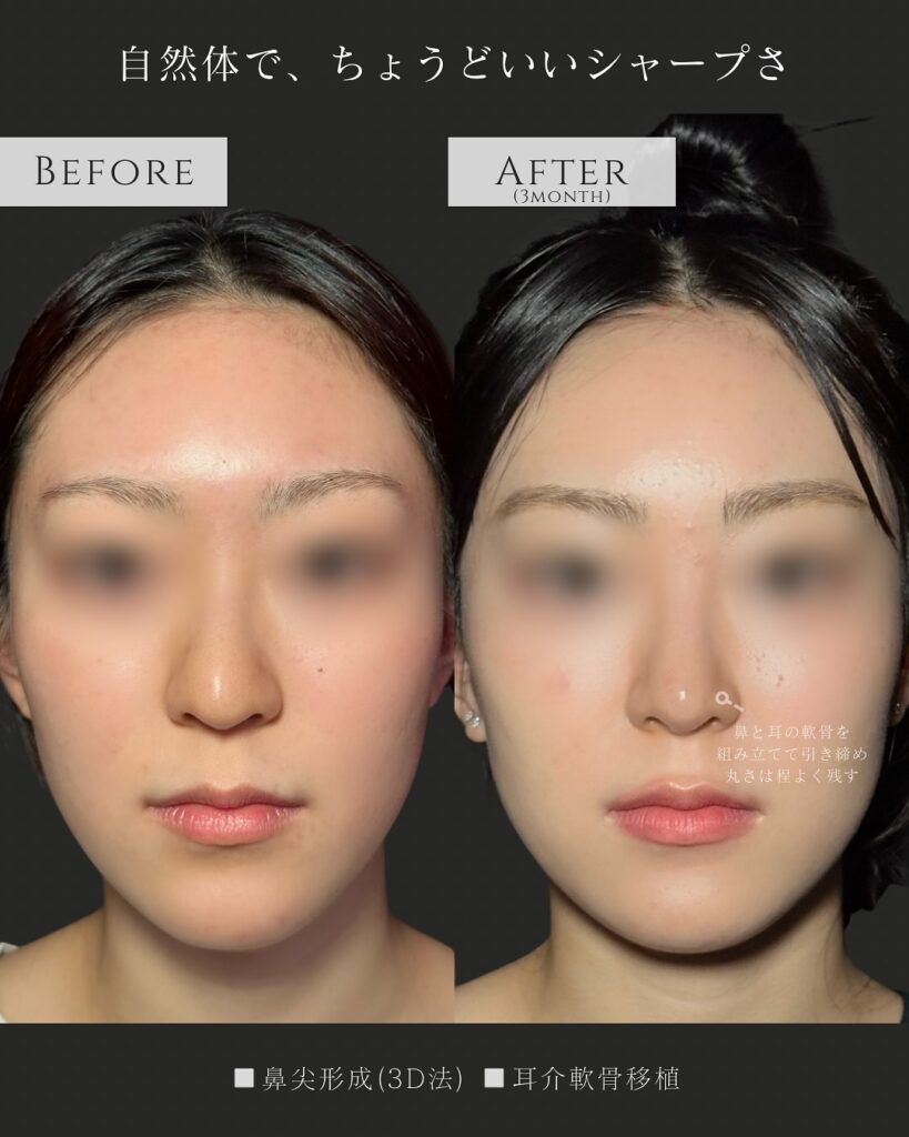 鼻尖形成と耳介軟骨移植の症例写真 (24)
