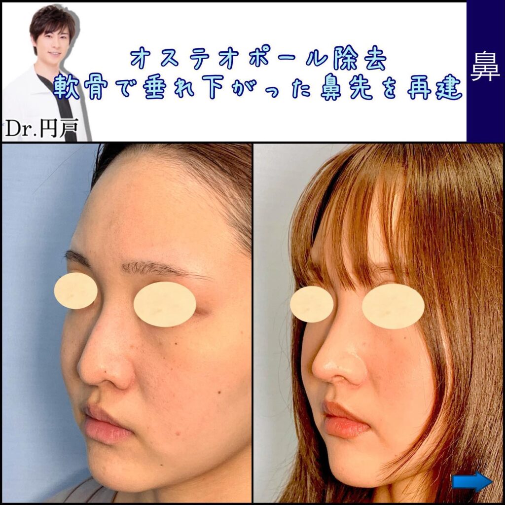 鼻の他院修正の症例写真