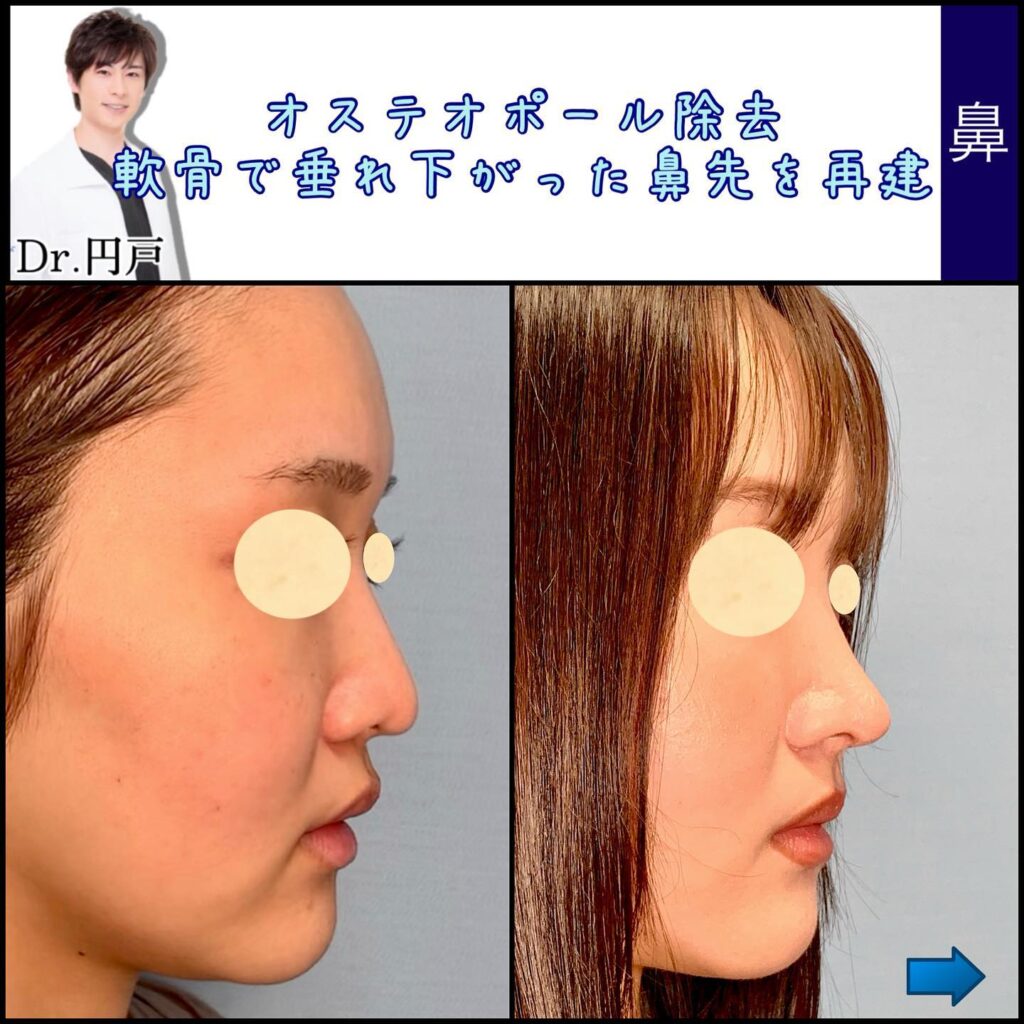 鼻の他院修正の症例写真