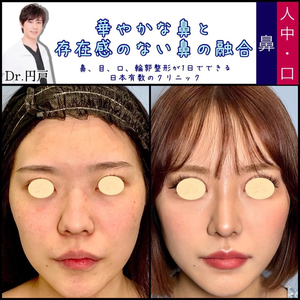 鼻中隔延長と軟骨移植とプロテーゼと脂肪注入と輪郭形成の症例写真 (4)