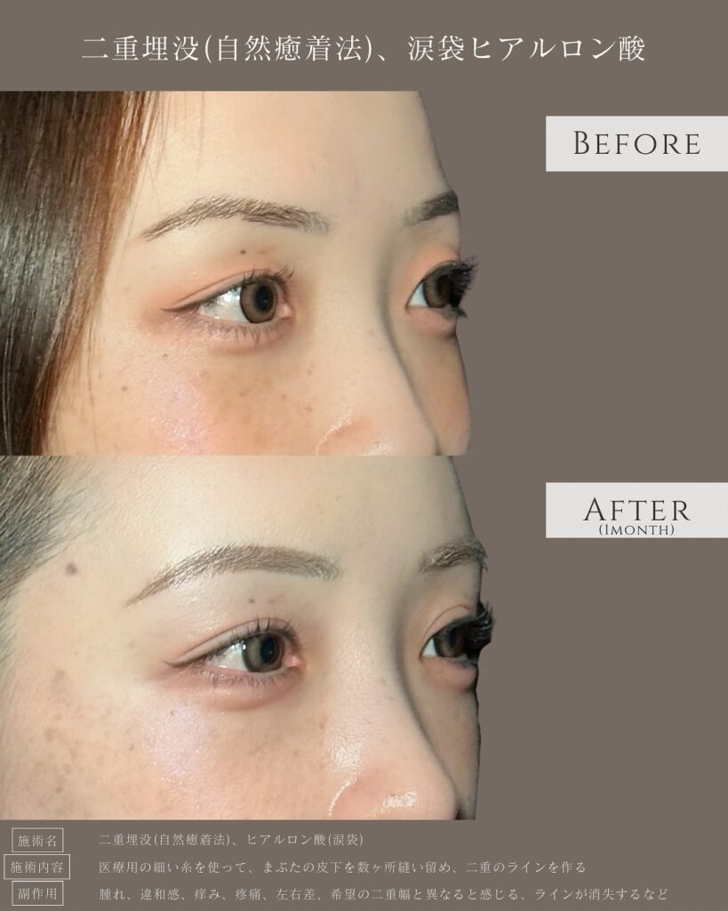 自然癒着法と涙袋のヒアルロン酸の症例写真 (3)