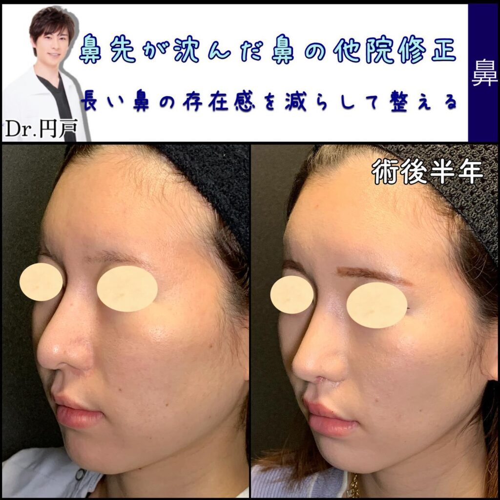 鼻の他院修正の症例写真