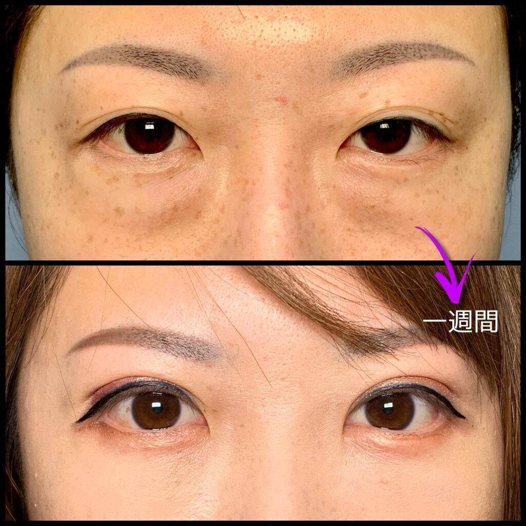 表ハムラ法の他院修正と脂肪注入と埋没法の症例写真 (2)