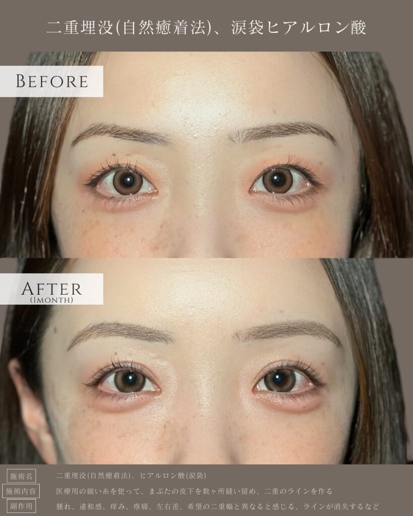 自然癒着法と涙袋のヒアルロン酸の症例写真 (2)