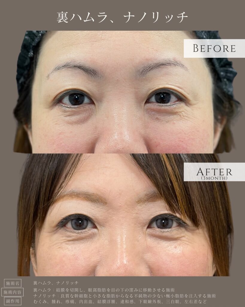 裏ハムラ法とナノリッチの症例写真 (8)