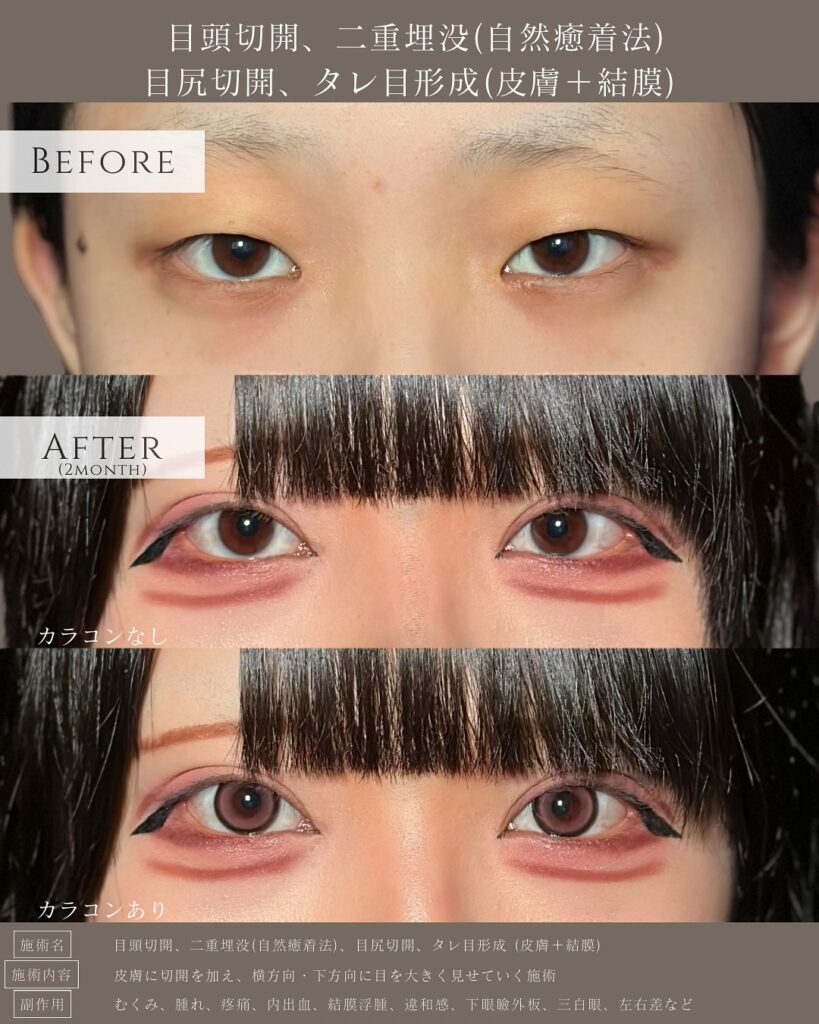 目頭切開と埋没法と目尻切開とタレ目形成の症例写真 (2)