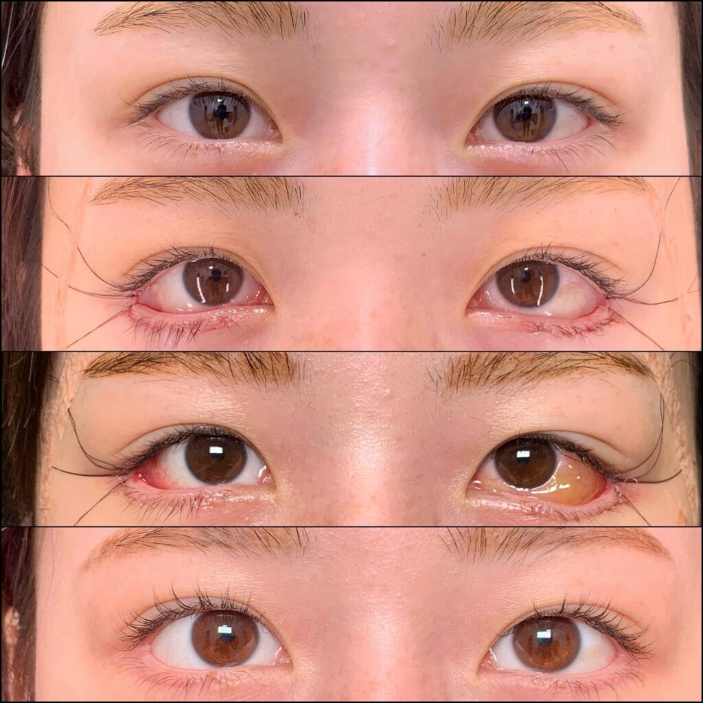 目尻切開と下瞼拡大の症例写真 (2)