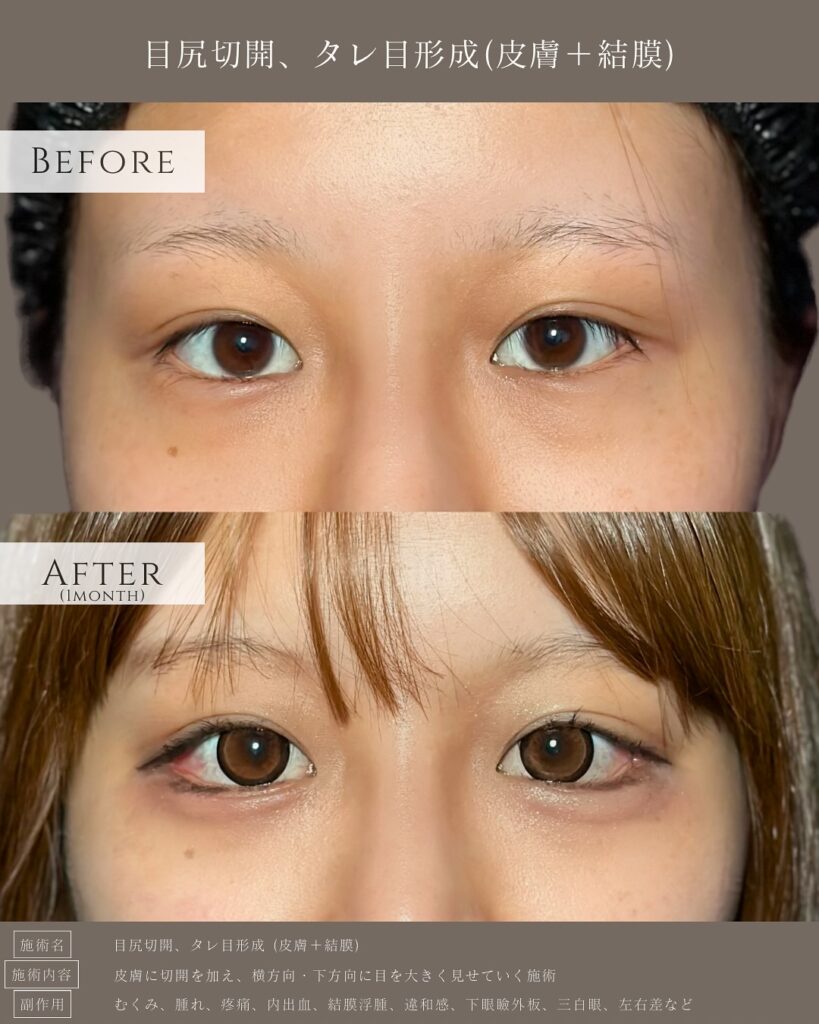 目尻切開とタレ目形成の症例写真 (7)