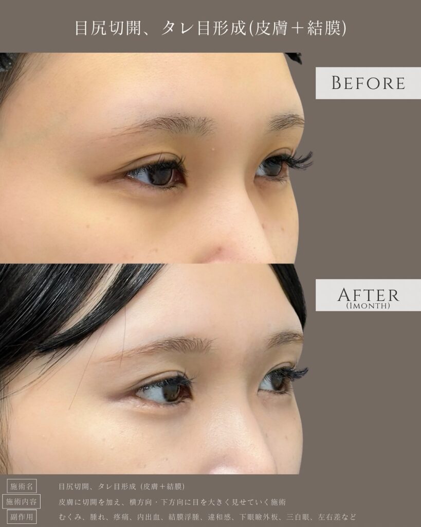 目尻切開とタレ目形成の症例写真 (26)