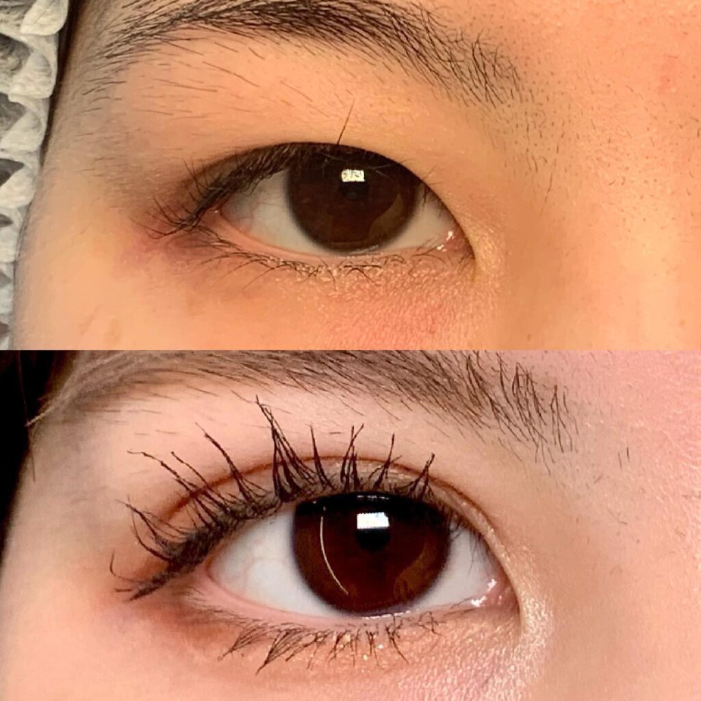 埋没法の症例写真 (13)