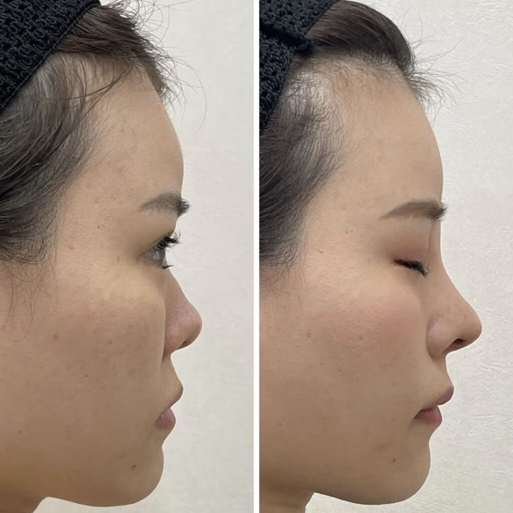 鼻フルと鼻唇角形成の症例写真