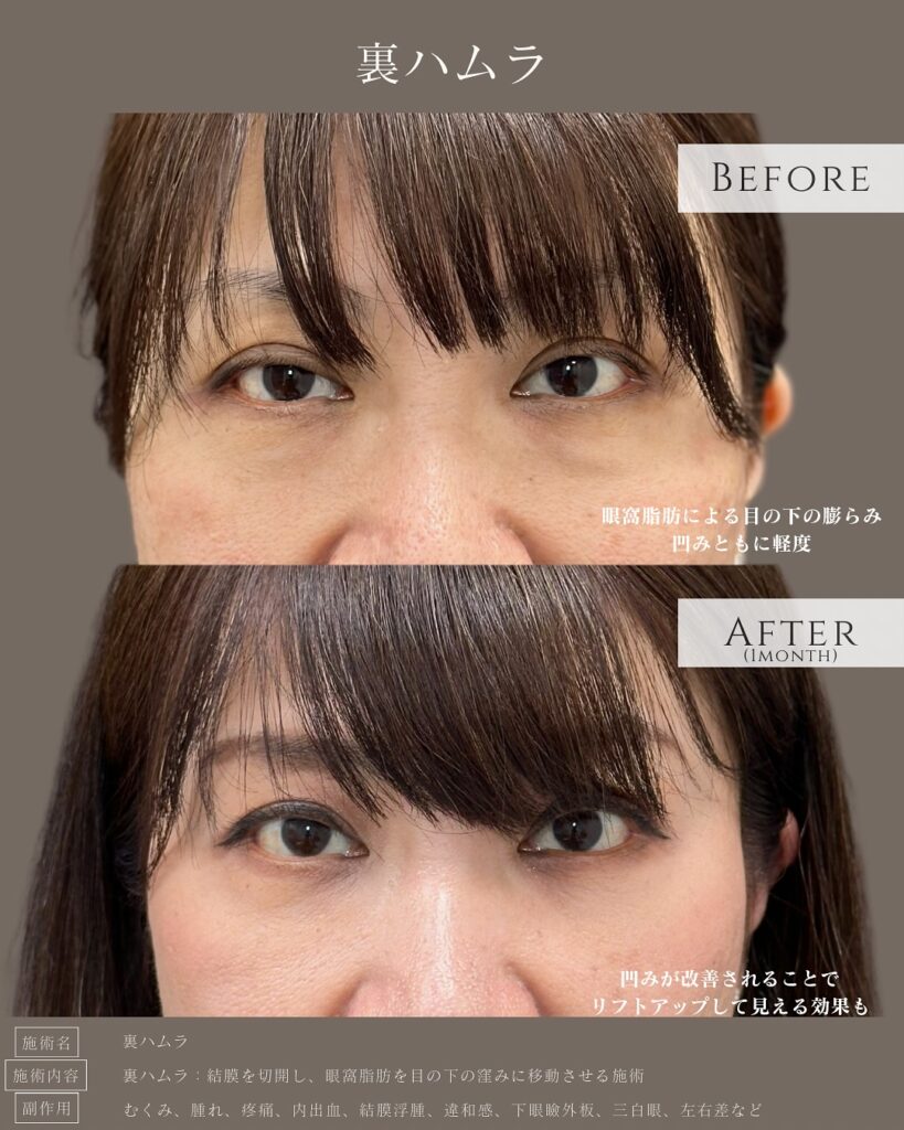 裏ハムラ法の症例写真 (38)