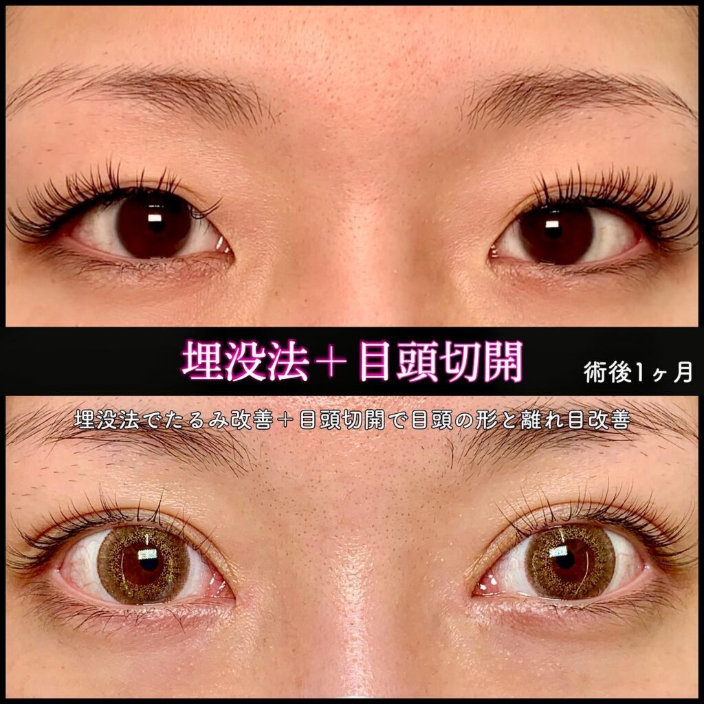 埋没法と目頭切開の症例写真