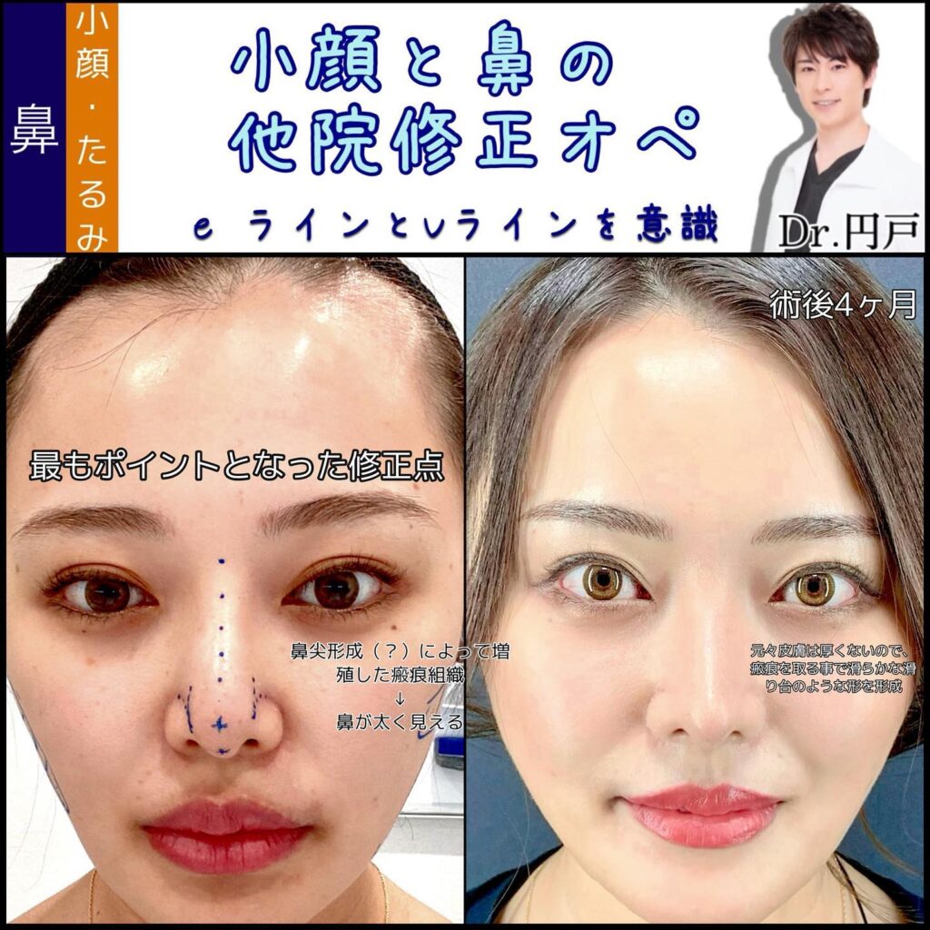 小顔と鼻の他院修正の症例写真 (1)
