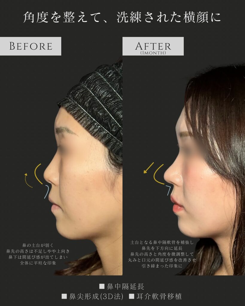 鼻中隔延長と鼻尖形成と耳介軟骨移植の症例写真 (4)