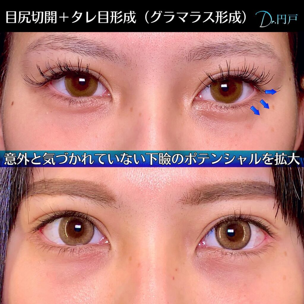 目尻切開とタレ目形成の症例写真