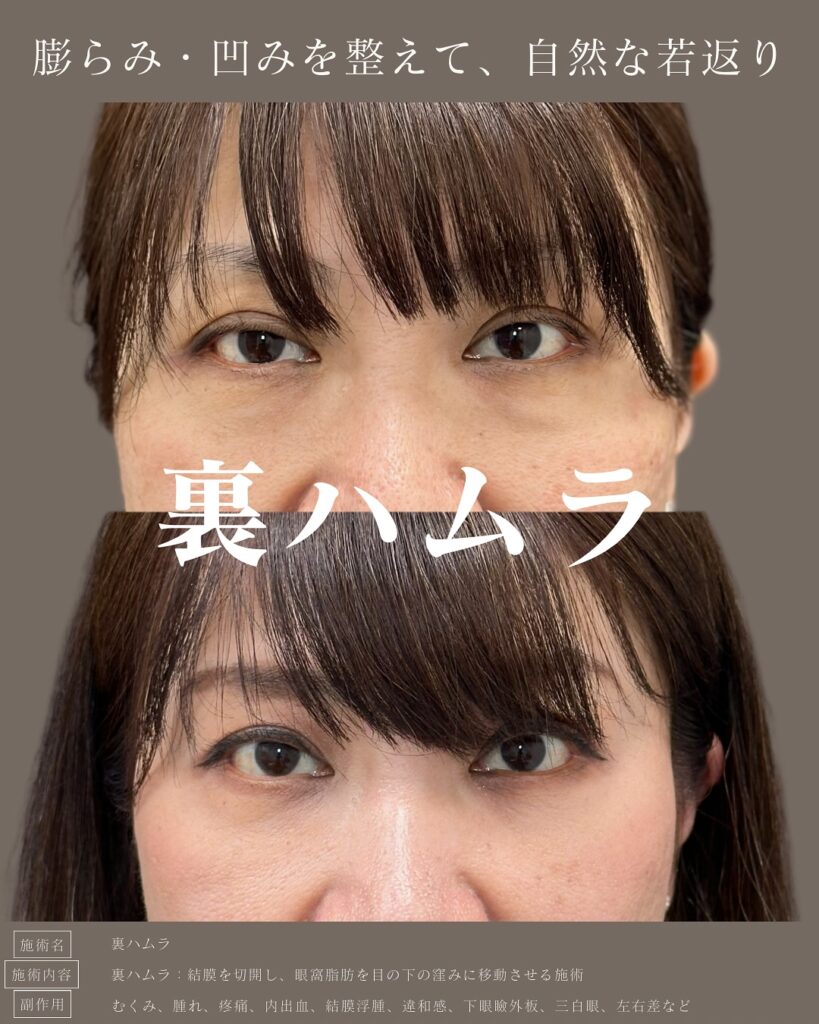 裏ハムラ法の症例写真 (39)