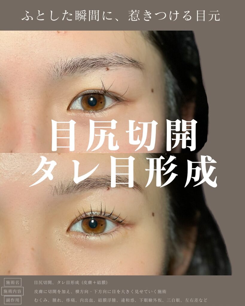 目尻切開とタレ目形成の症例写真 (16)