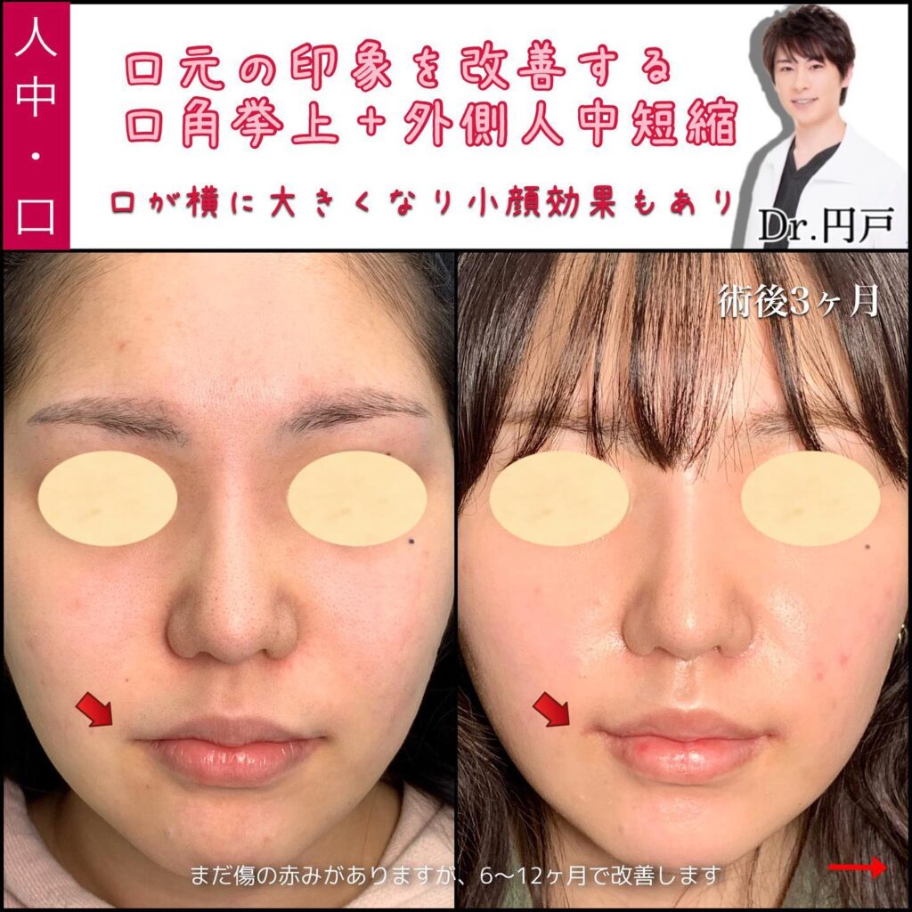 口角挙上と外側人中短縮の症例写真