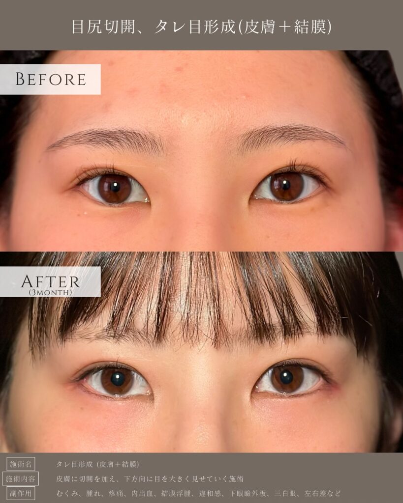 タレ目形成の症例写真 (13)