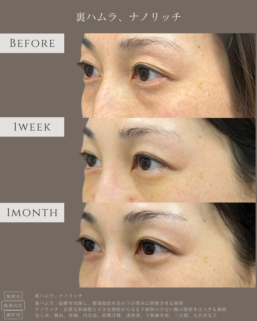 裏ハムラ法とナノリッチの症例写真 (21)