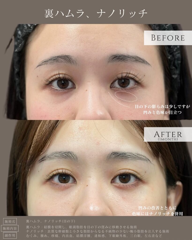 裏ハムラ法とナノリッチ症例写真 (2)