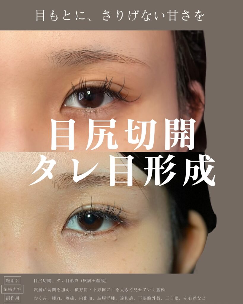 目尻切開とタレ目形成の症例写真 (29)