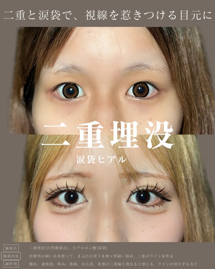 自然癒着法と涙袋のヒアルロン酸の症例写真 (6)