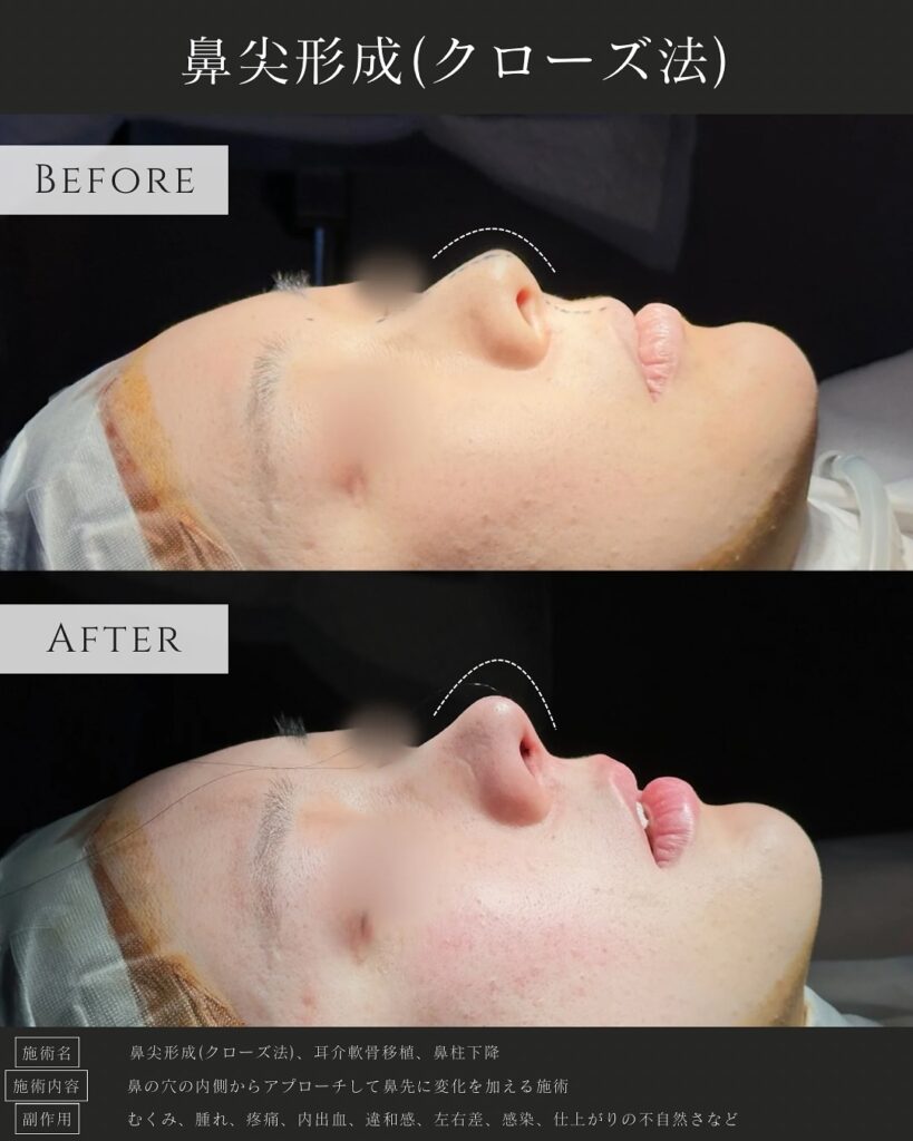 鼻尖形成と耳介軟骨移植と鼻柱下降の症例写真 (4)