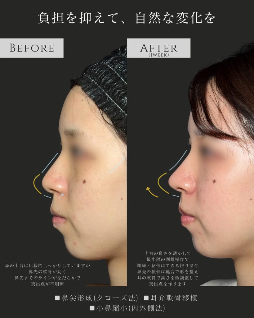 鼻尖形成と耳介軟骨移植と小鼻縮小の症例写真 (2)