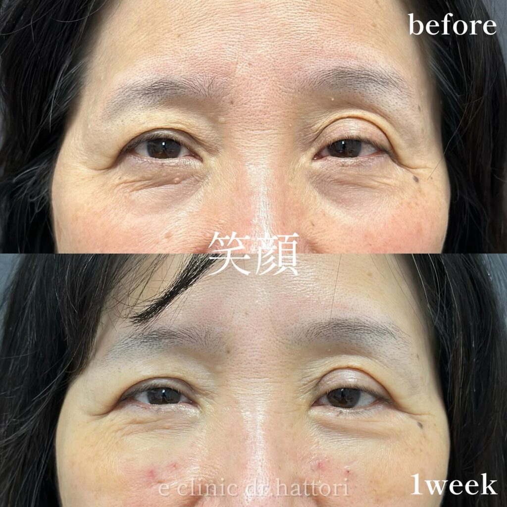 裏ハムラ法の症例写真 (81)