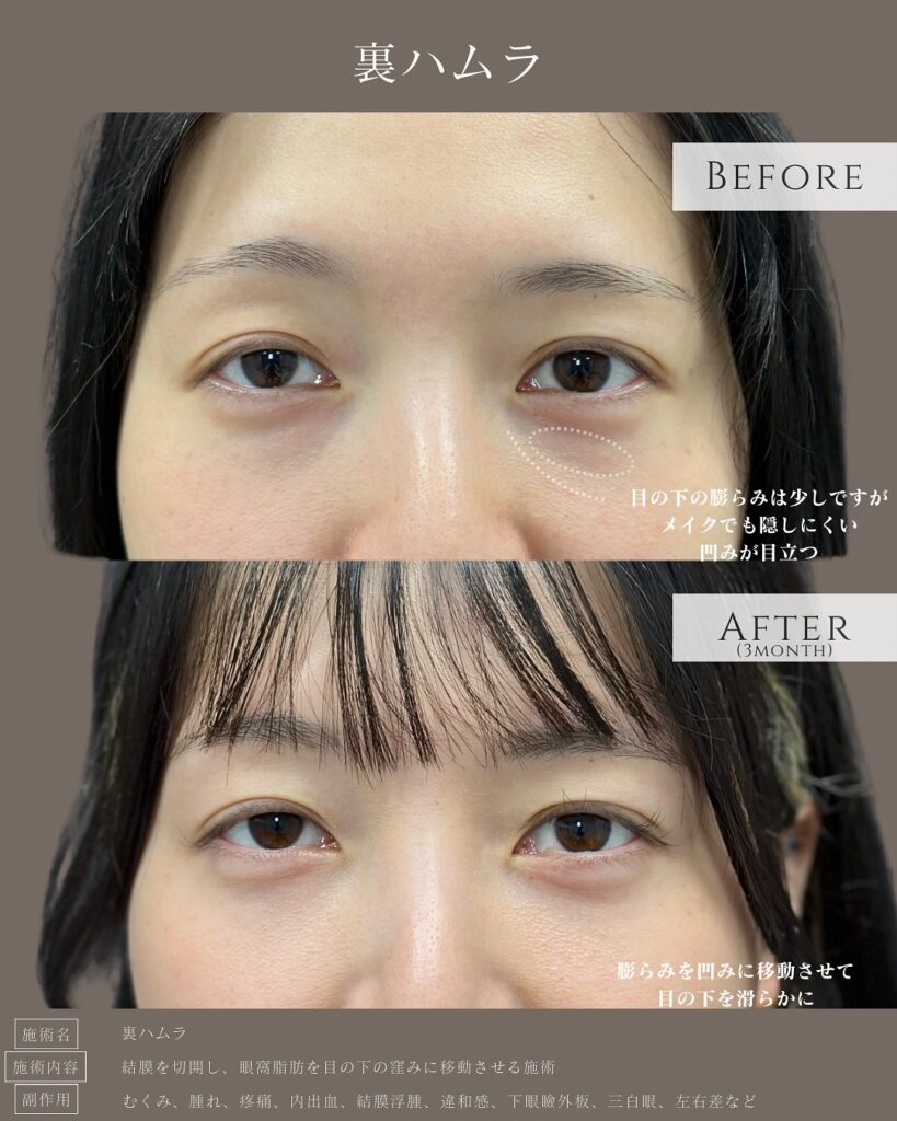 裏ハムラ法の症例写真 (42)