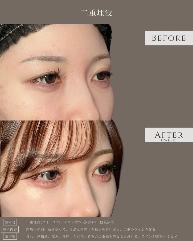 埋没法と他院の抜糸の症例写真 (2)