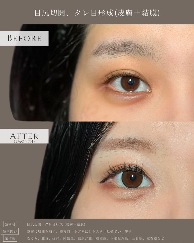 目尻切開とタレ目形成の症例写真 (14)