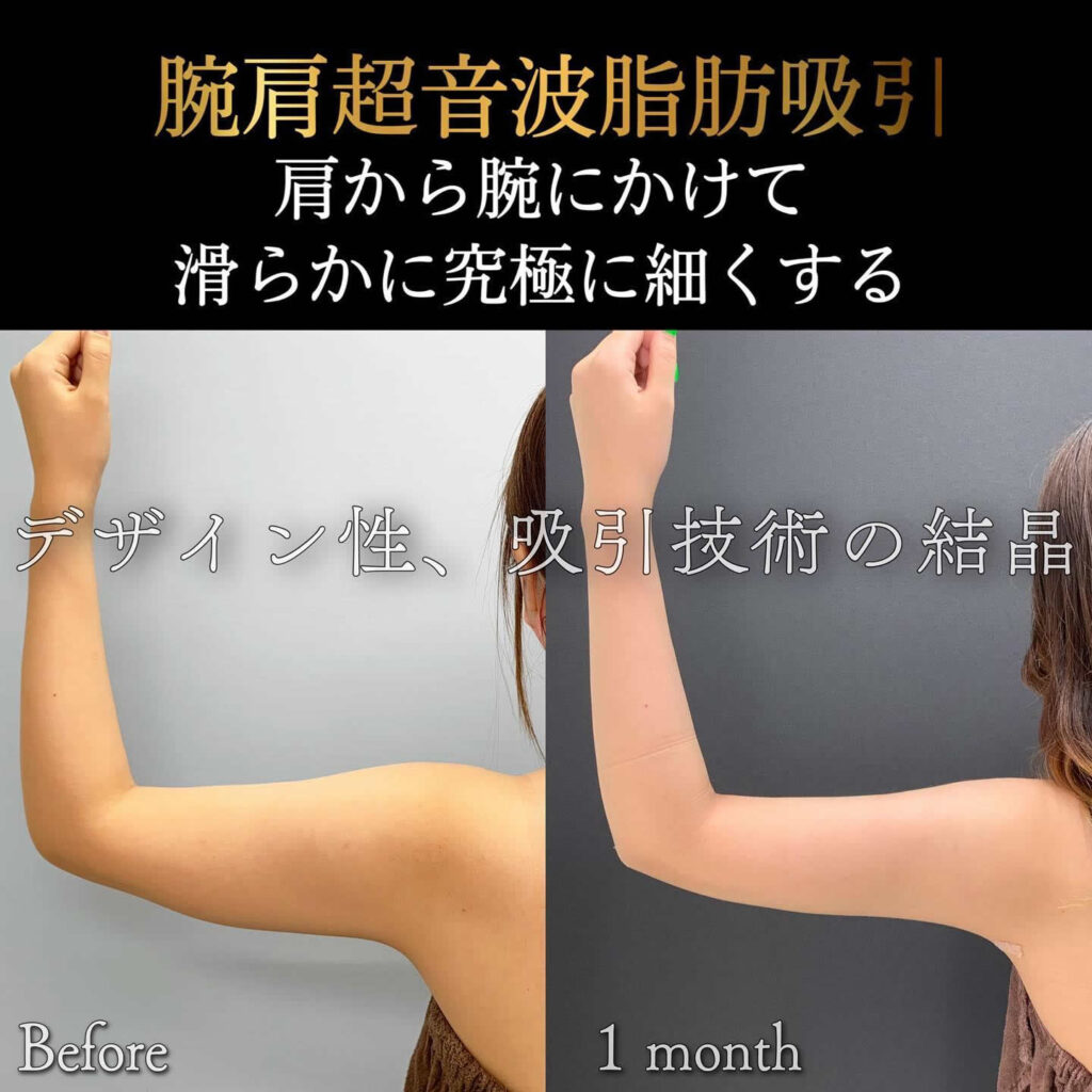 二の腕の脂肪吸引