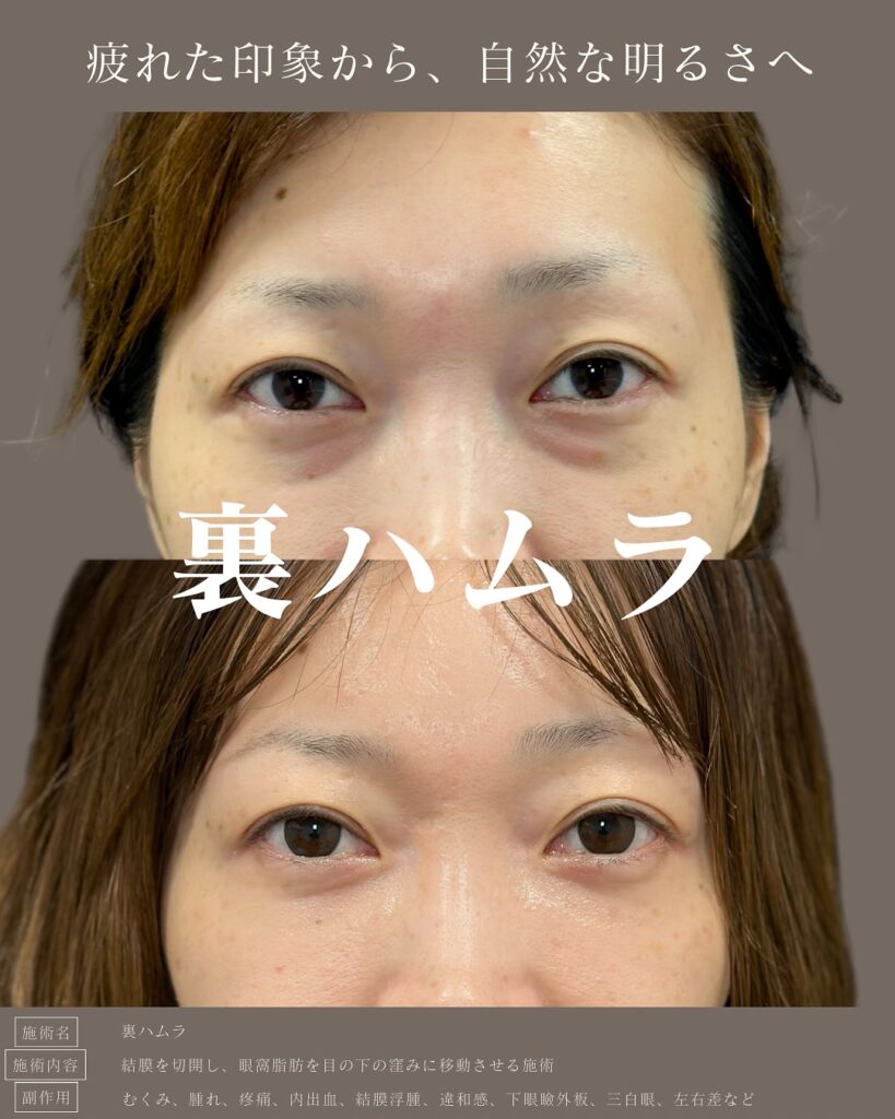 裏ハムラ法の症例写真 (4)