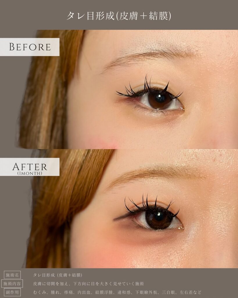 タレ目形成の症例写真 (9)