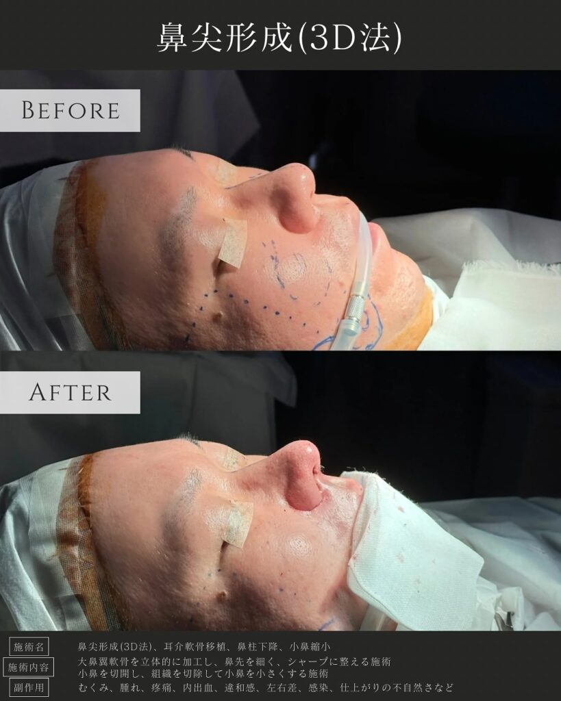 鼻尖形成と耳介軟骨移植と小鼻縮小と鼻柱下降の症例写真 (1)