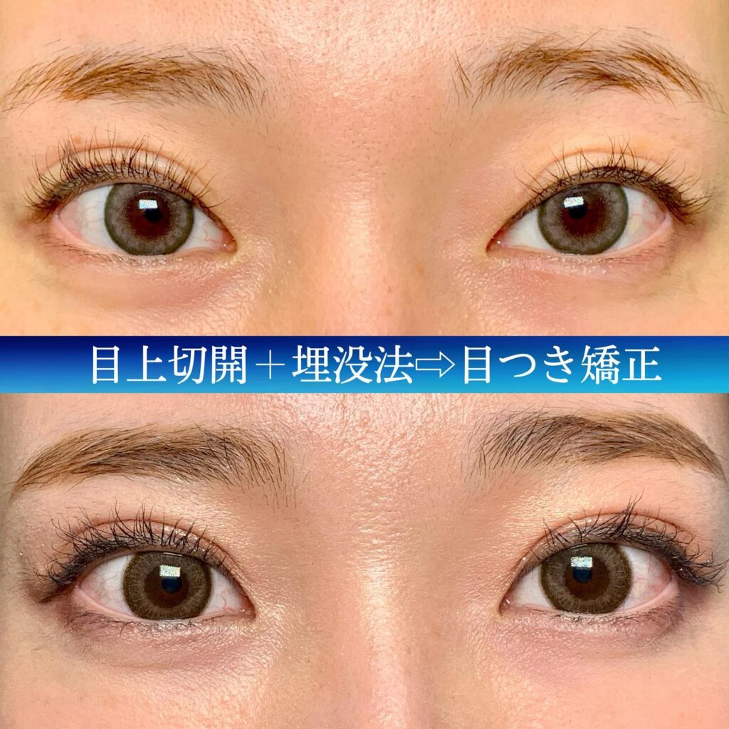 目上切開と埋没法の症例写真 (2)