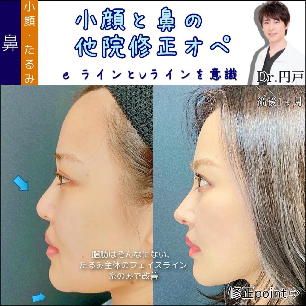 小顔と鼻の他院修正の症例写真 (3)