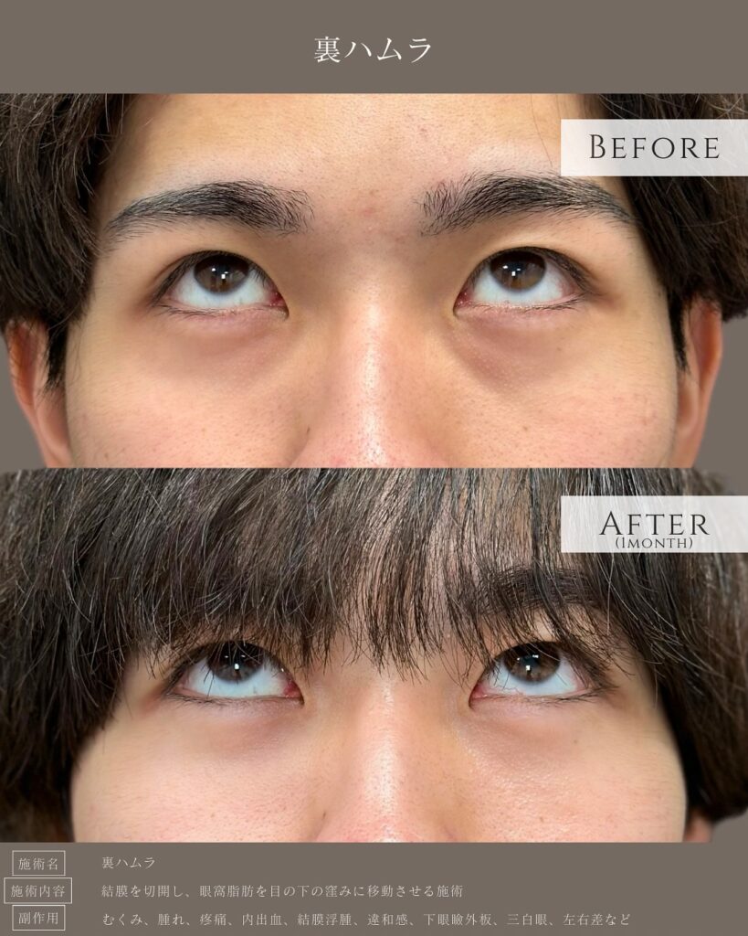 裏ハムラ法を受けた男性の症例写真 (6)