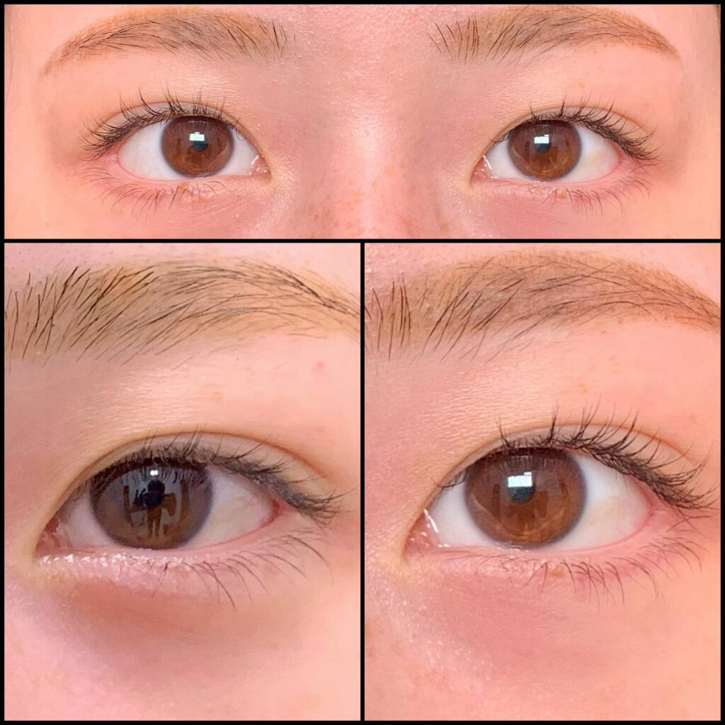 目尻切開と下瞼拡大の症例写真 (6)