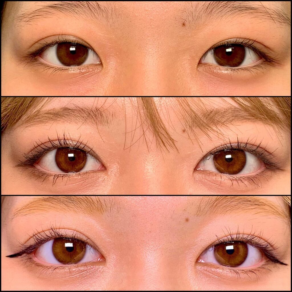 目頭切開と下瞼拡大と目尻切開靭帯移動の症例写真 (2)