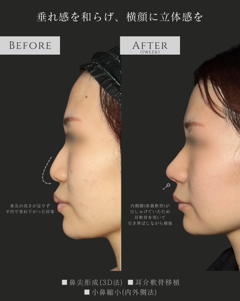 鼻尖形成と耳介軟骨移植と小鼻縮小の症例写真 (6)