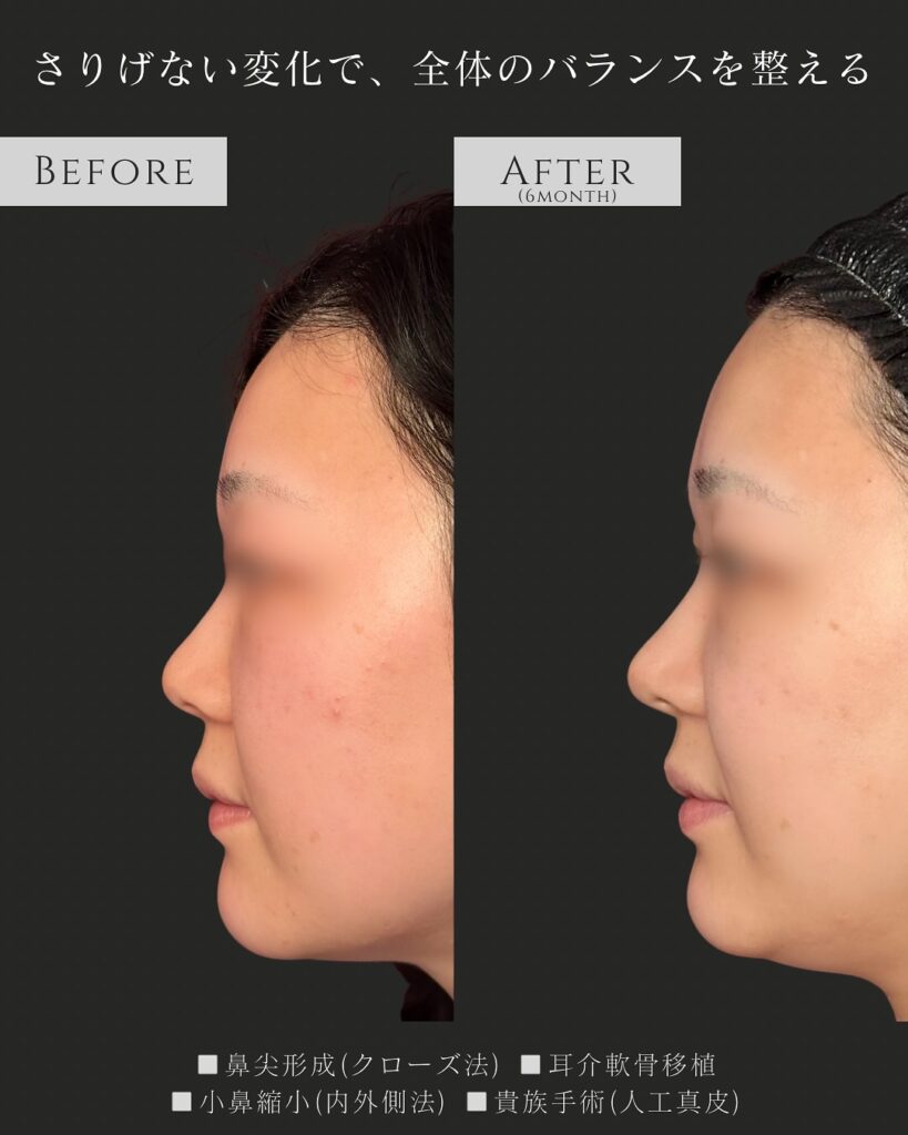 鼻尖形成と耳介軟骨移植と小鼻縮小と貴族手術の症例写真 (3)