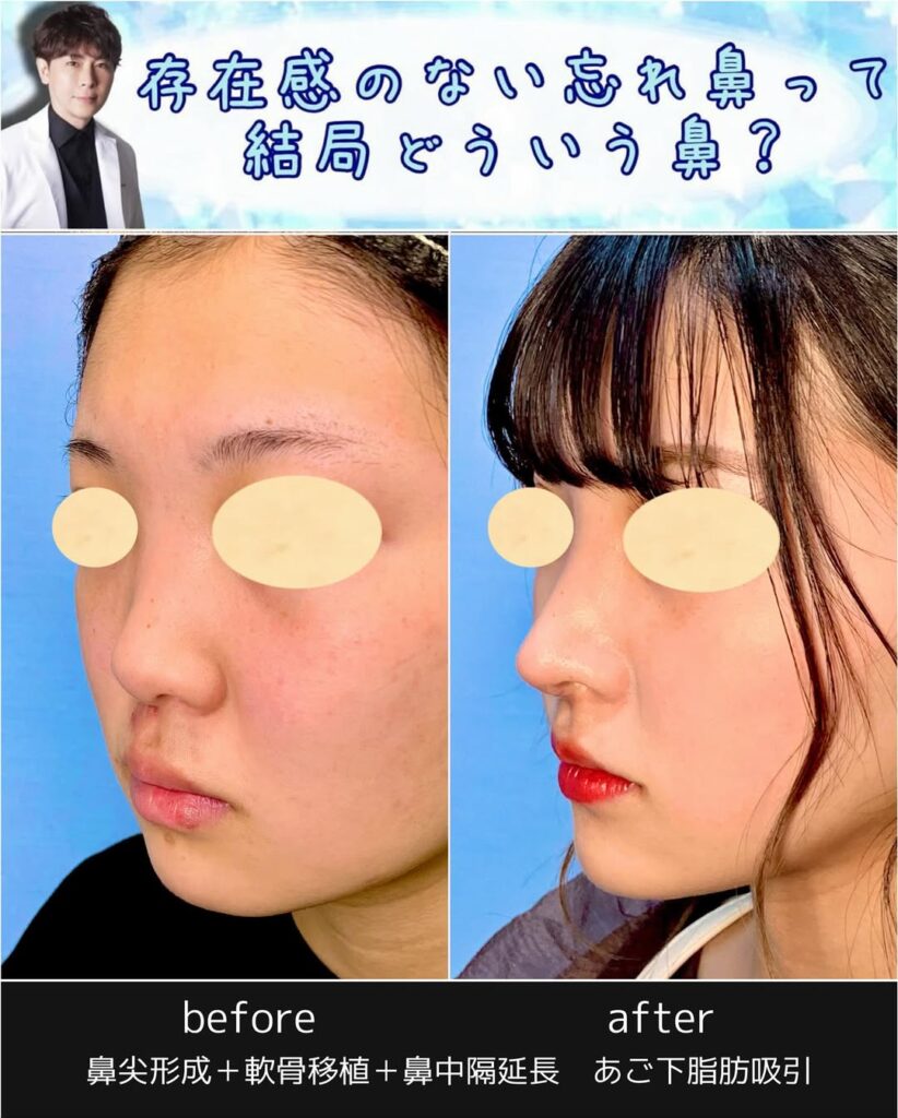 鼻尖形成と鼻中隔延長と軟骨移植と顎下の脂肪吸引の症例写真 (2)