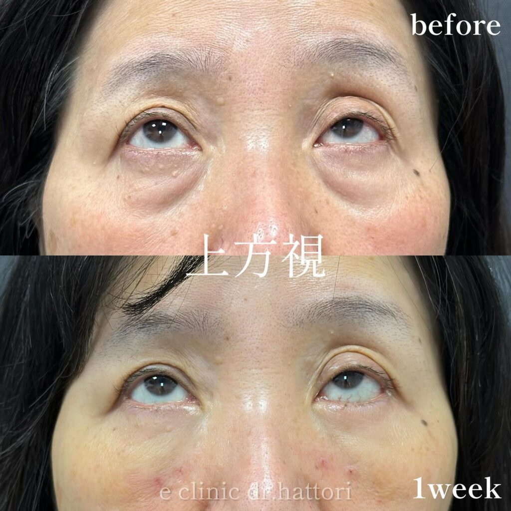 裏ハムラ法の症例写真 (80)