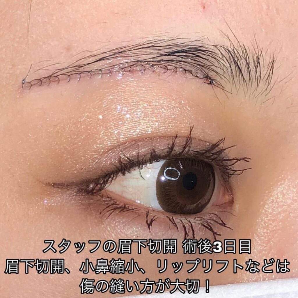 眉下切開+ROOF除去と全切開と眼瞼下垂の症例写真 (1)