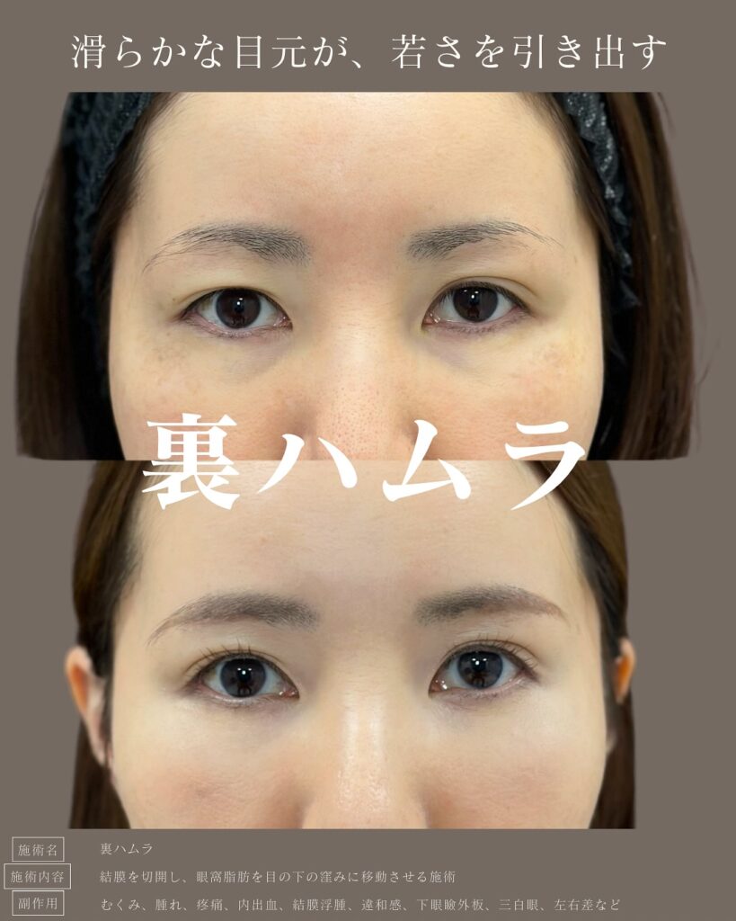 裏ハムラ法の症例写真 (11)